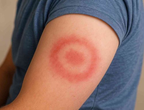 How to Manage Chronic Lyme Disease – A Holistic Path to Healing